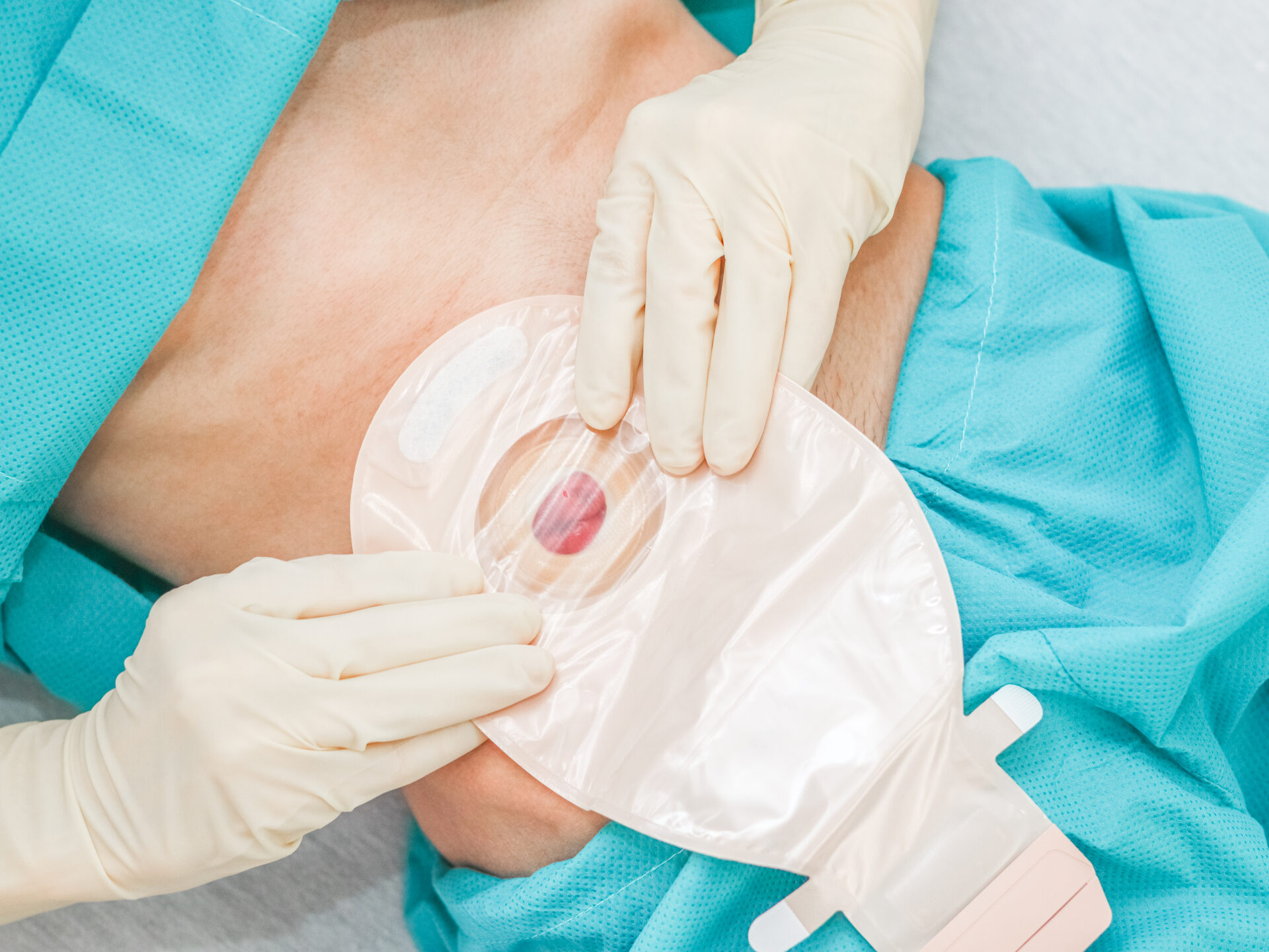 A young caucasian patient lies on a bed in a disposable pajama with an open abdomen with postoperative scars, an intestine out and a clostoma sack that he glues with sterile gloves on his hands, flat lay close-up, step 5. Medical concept, abdominal diseases, surgery, step by step instructions.